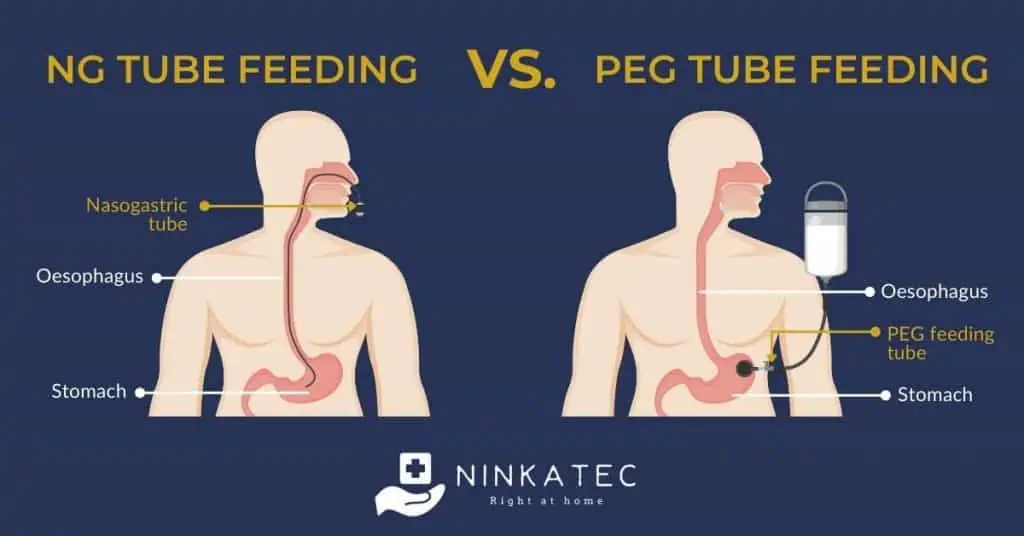 Ninkatec_NG tube vs. PEG tube feeding