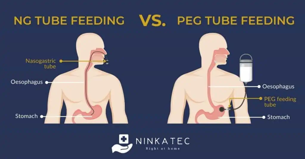 Enteral Nutrition And Care Of Nasogastric Tube NG Tube In Home Care Patients Ninkatec