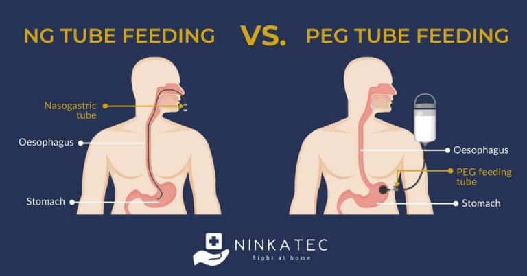 Enteral Nutrition And Care Of Nasogastric Tube NG Tube In Home Care   Ninkatec NG Tube Vs. PEG Tube Feeding 1 768x402 