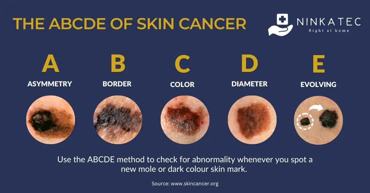 Ninkatec - The ABCDE Method to Identify Atypical Skin Spot and Skin Cancer Symptoms