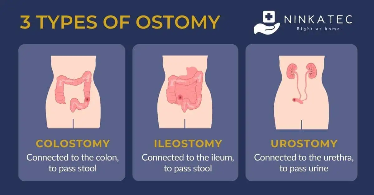 Discharge Instructions: Changing Your Ostomy Pouch | Saint Luke's Health  System